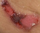 ISTAP type 2 skin tear