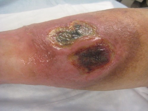 Venous leg ulcer pre debridement