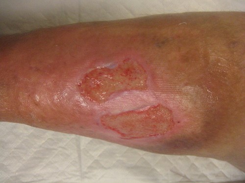 Venous leg ulcer post debridement and compression