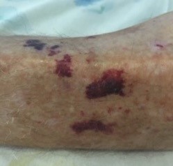 Senile purpura