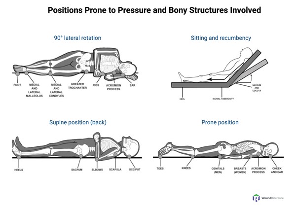Positions prone to pressure and bony structures involved