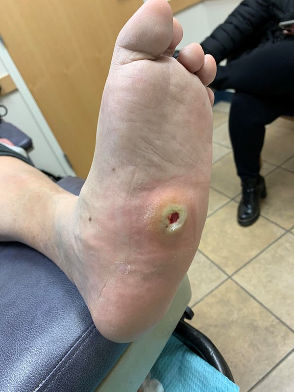 Charcot foot ulcer