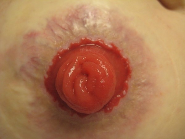 Peristomal varices (by Lebedinskaya N)