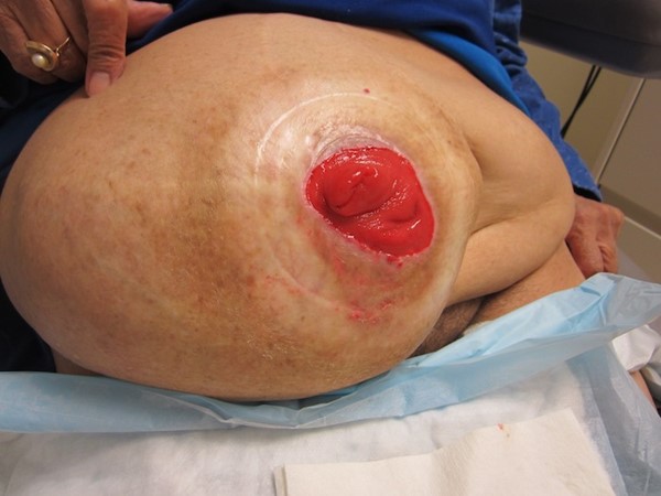 Parastomal hernia (by Lebedinskaya N)