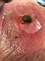 End ileostomy with severe peristomal irritant contact dermatitis with fungal component