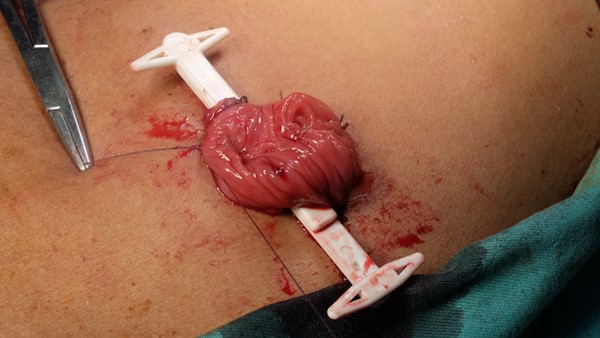 Rod (or bridge) placed under the loop of intestine