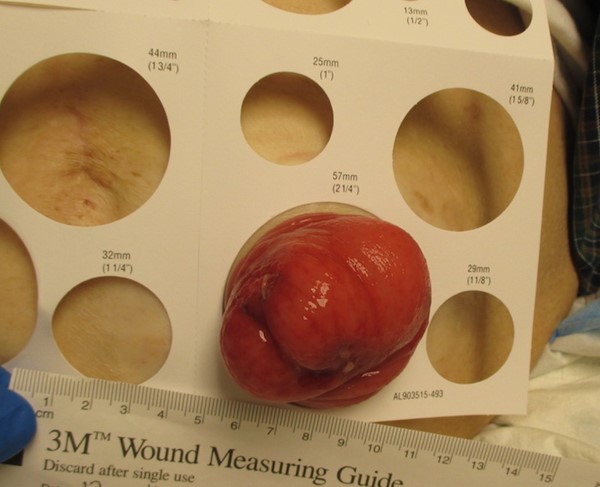 End stoma prolapse, Valsalva maneuver (by Lebedinskaya N)
