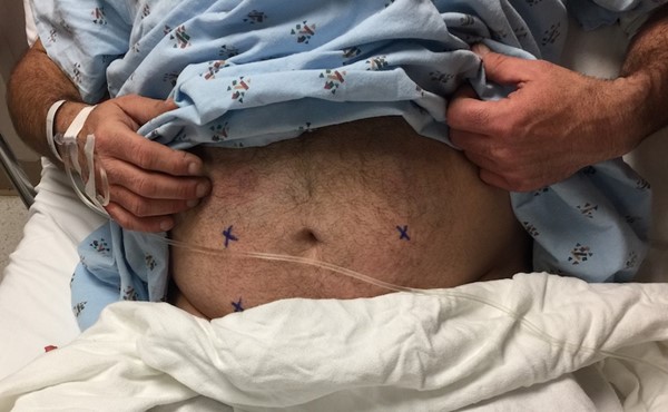Preoperative stoma marking