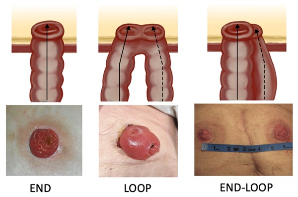 Types of stoma (end-loop stoma by Lebedinskaya N)