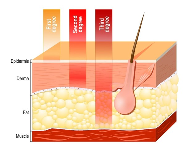 Skin layers and classification of burn injury