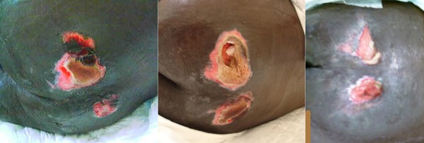 Healing stage 4 pressure ulcers/injuries on the buttocks on a darkly pigmented patient.