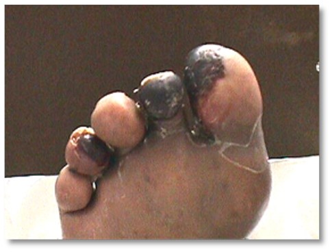 Eschar: dry, adherent, hard