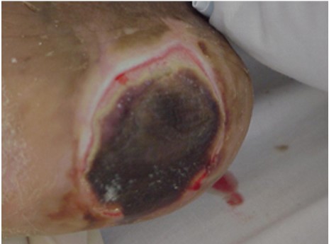 Eschar: loose, soft, spongy