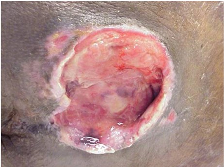 Clean, but non-granulating wound