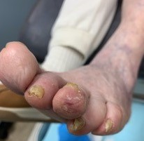 DFU, one month after surgical offloading