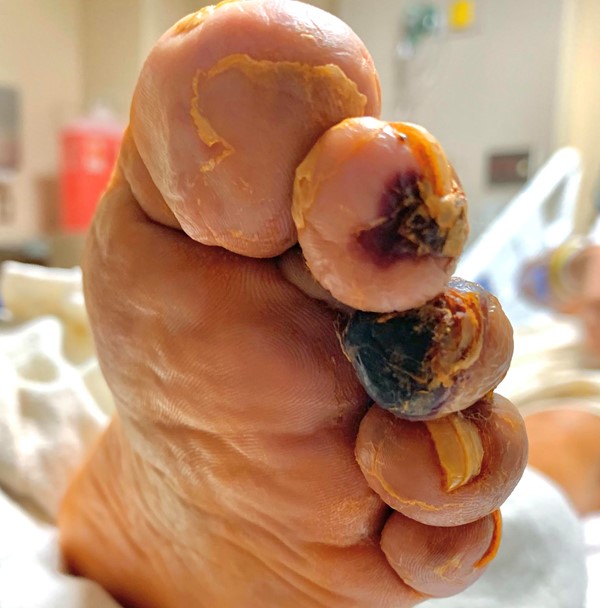  Example of arterial ulcer to tip of toe 