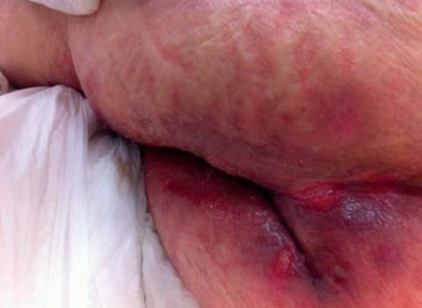 Association of IAD and Stage 2 Pressure Injury