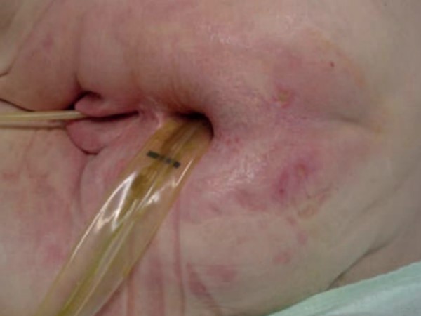 Fig. 4: Case 2. Fourteen days after placement of urine and fecal diversion catheters.