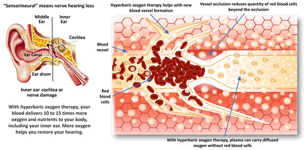 Efectos de la TOHB en la pérdida auditiva neurosensorial súbita idiopática