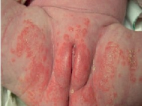 IAD - Persistent redness with clinical signs of infection