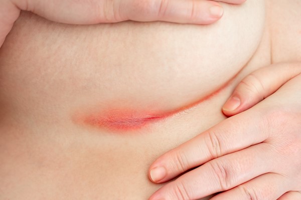 Intertrigo candidiasis