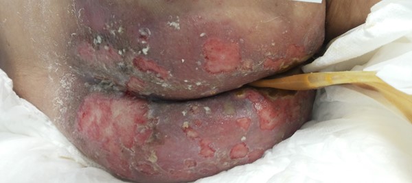 Case 1. First day of placement of urinary and fecal diversion catheters. 