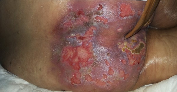 Fig. 2. Case 1.  Five days after placement of urine and fecal diversion catheters. 