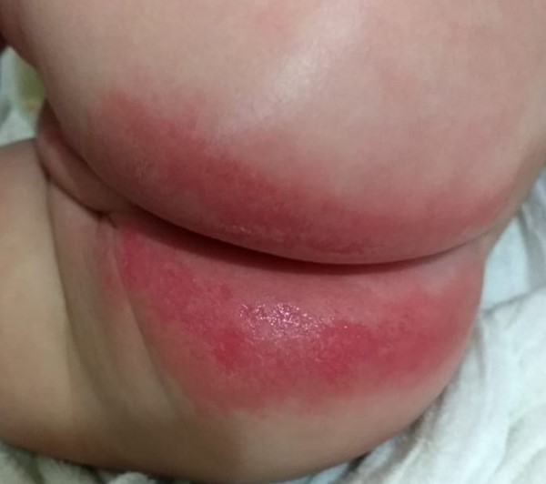 Incontinence associated dermatitis with exudative and ulcerated lesions