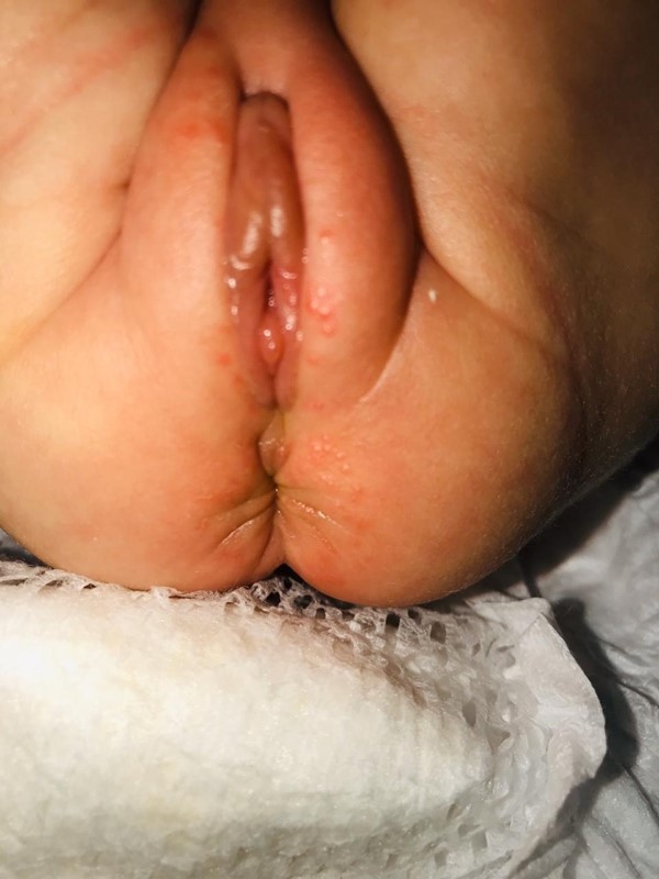 Incontinence associated dermatitis with signs of infection 