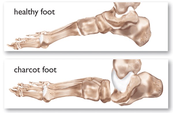 Charcot arthropathy