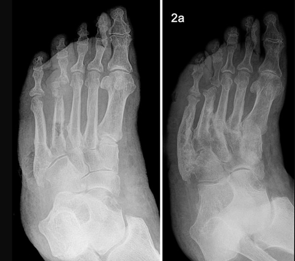 Charcot foot. By Hellerhoff, http://www.gnu.org/copyleft/fdl.html