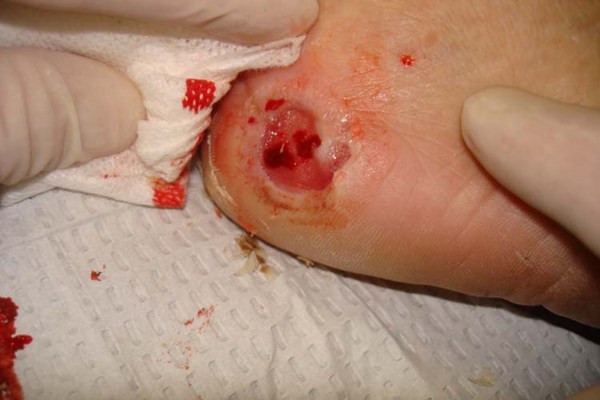 Diabetic foot ulcer, heel. By Jonathan Moore, https://creativecommons.org/licenses/by/3.]