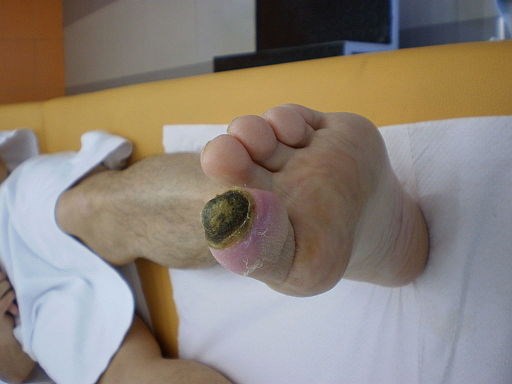 Ischemic diabetic foot ulcer