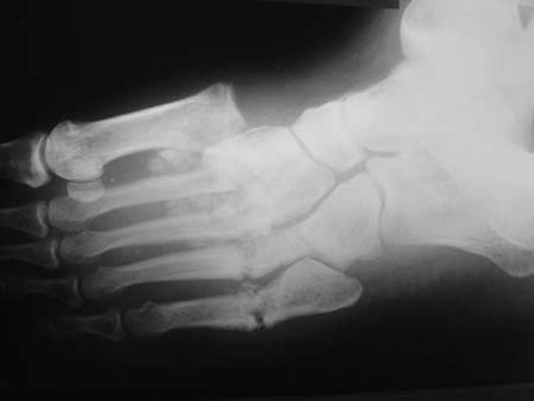 Charcot arthropathy X-ray, Wiki Commons