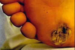 Electrical burn, exit wound. By Occupational Safety and Health Administration