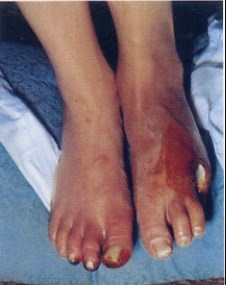 Thromboangiitis obliterans. By Onthelist, https://creativecommons.org/licenses/by-sa/4.0