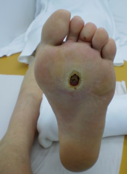Congenital neuropathic foot ulcer. By CC-BY-3.0-RS, https://sr.wikipedia.org