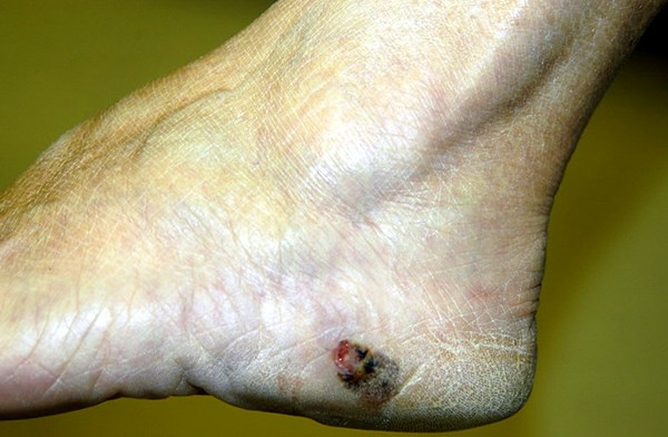 Melanoma. By Will Blake. http://creativecommons.org/licenses/by-sa/3.0