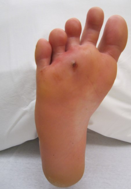 Traumatic puncture. By James Heilman, MD, http://www.gnu.org/copyleft/fdl.html